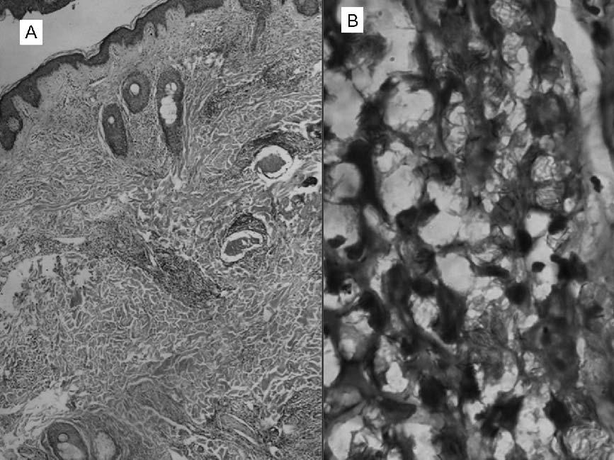 Uncommon presentations of leprosy 249 Figure 4. (Case 2) Atrophic epidermis with dense dermal chronic inflammatory infiltrate around pilosebaceous units and nerve fibrils (Figure 4A: H&E 10).