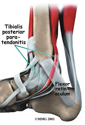 Introduction Because we use our feet continuously, tendonitis in the foot is a common problem. One of the most frequently affected tendons is the posterior tibial tendon.