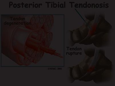 Treatment What can be done for the condition? Nonsurgical Treatment condition is called tendonosis. The area of tendonosis in the tendon is weaker than normal tendon.