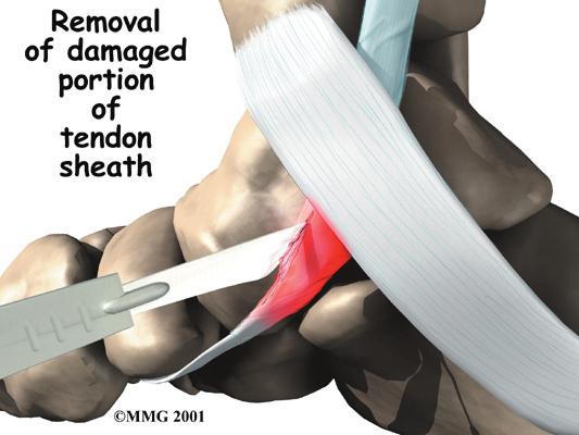 Symptoms What does tendonitis of the foot feel like? The symptoms of tendonitis of the posterior tibial tendon include pain in the instep area of the foot and swelling along the course of the tendon.