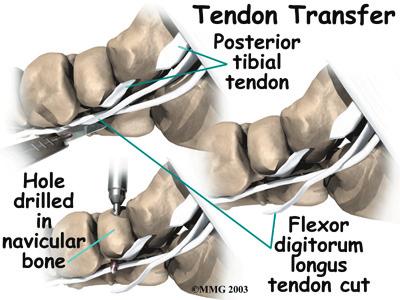 Tendon Repair A degenerated tendon that has not ruptured may only need to be repaired. The surgeon divides the sheath around the tendon. Areas where the tendon is degenerated are carefully removed.