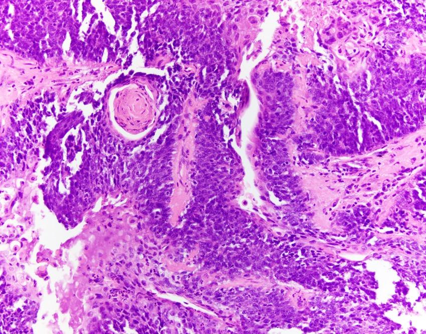 Nut Carcinoma Thought to represent a variant of squamous cell carcinoma- abrupt keratinization may be seen Most cases harbor t(15;19) BRD4-NUT