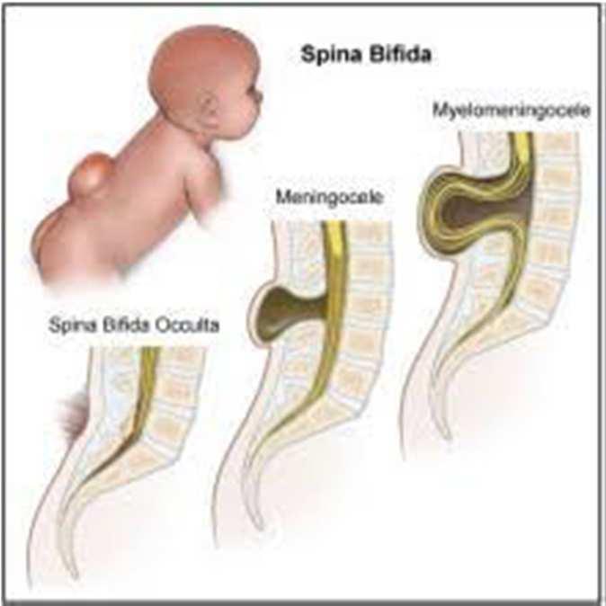 Carbemazepine Increased risk of spina bifida (26 cases per 10,000 vs 10 cases per 10,000 with no exposure) neural tube defects, anomalous pulmonary venous
