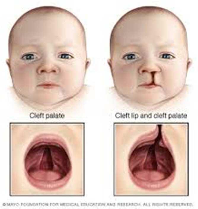 Lamotrigine Early reports had suggested an increased risk of oral clefts, but recent reports from multiple international registries fail to demonstrate an