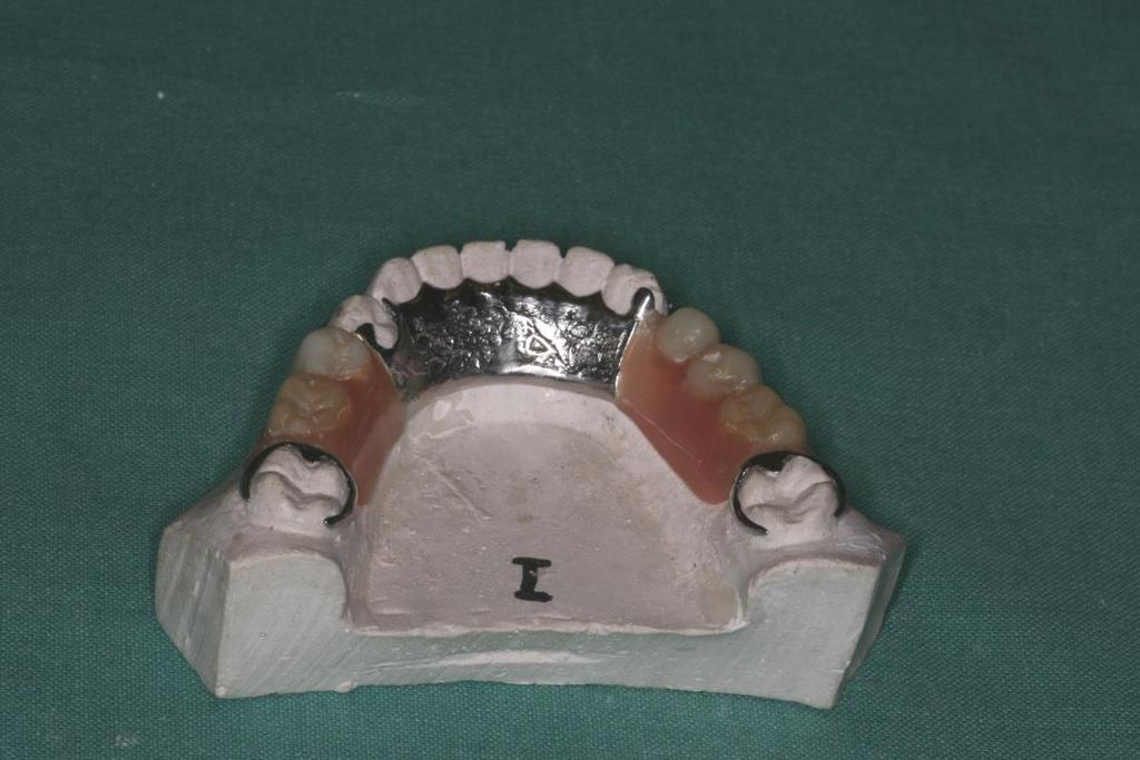 Class I and II dentures with