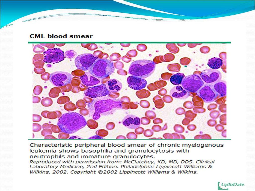 Clues to the diagnosis of CML Unexplained & persistent leukocytosis Unexplained thrombocytosis