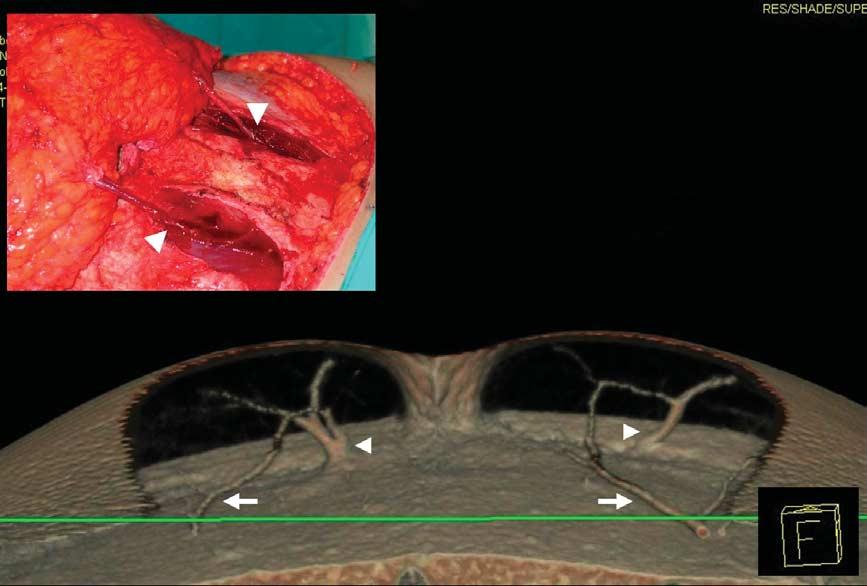 Preoperative MSCT for DIEAP planning 589 Figure 3 3D-VR of the main perforators vessels (arrow heads) correlated with the surgical findings in a case of a