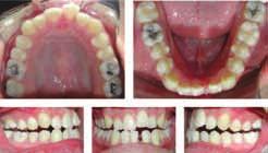 Thus design your attachment and place them on the clinical crowns taking these three things into consideration.