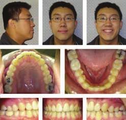 continued from page 47 One year post retention: In Review: 1) Anterior crossbite corrected, upper cuspid guidance on lower first bicuspids 2) Gingival margins are even for improved aesthetics via