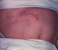 Case 3 What s on my abdomen? A 62-year-old woman with psoriatic arthritis presents with an erythematous, irregular, serpiginous lesion in the left lower quadrant of her abdomen.