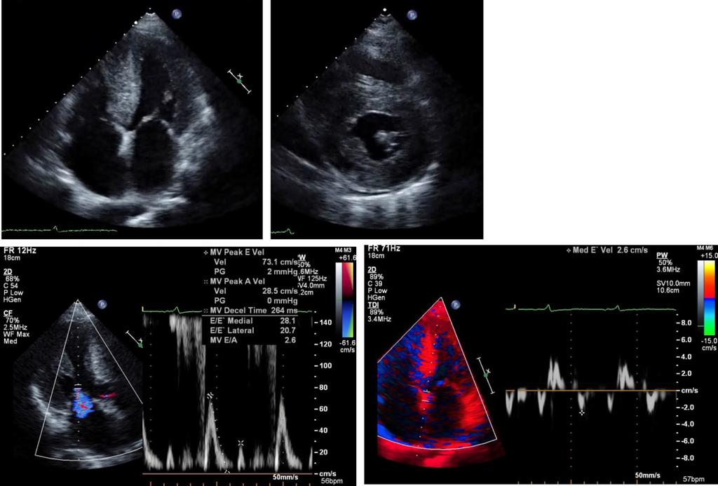 Ymmoto et l. Journl of Medicl Cse Reports (2018) 12:370 Pge 3 of 5 RV LV RV LV PE RA LA Fig. 2 Trnsthorcic echocrdiogrphy in picl four chmer (, left pnel) nd short xis view (right).