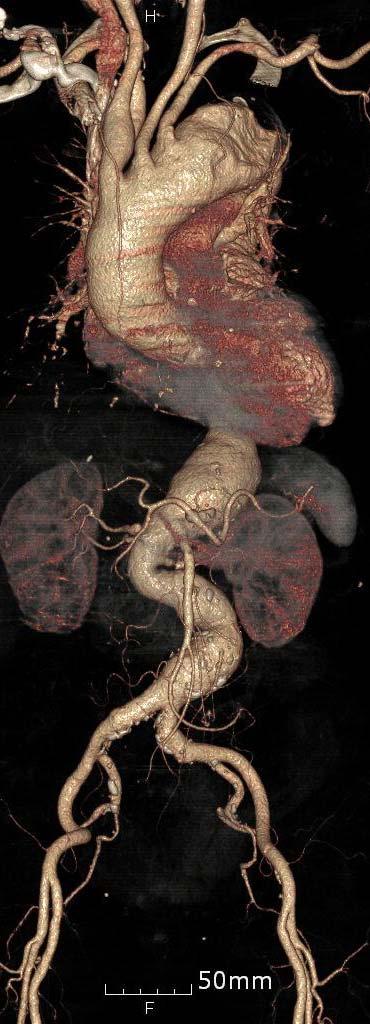 CT-aorta.