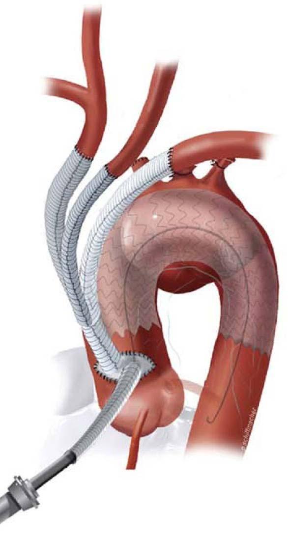 .Type I :.Isolated aortic arch aneurysm.brachiocephalic bypass with endovascular repair of the aortic arch.arch debranching procedure :.