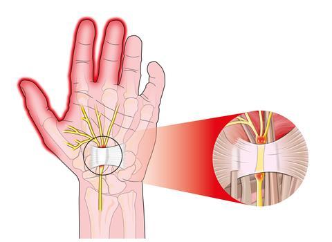 Carpal Tunnel Syndrome True Carpal Tunnel Syndrome (CTS) is caused from pressure on the median nerve in