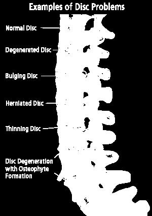 Disc Problems Causes: Age, heavy physical work, and obesity.