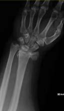 INTRA-ARTICULAR FRACTURES Articular Fractures Wrist fractures SUMMARY