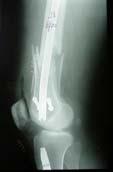 TIBIA FRACTURES Most common long bone fracture 492,000