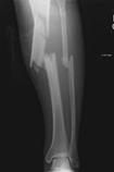 CLOSED TIBIAL SHAFT FRACTURE Most displaced tibial shaft fractures can be treated in a cast? A. true B.