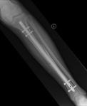 ADVANTAGE OF IM NAIL Less malunion Early weight-bearing Early motion Early WB (load sharing) Patient satisfaction L Bone, JBJS Cost Less expensive to society when compared to casting Busse