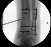 bone quality and mechanism of injury (i.