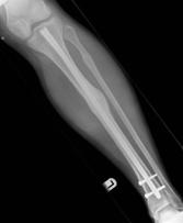 TYPES OF BONE HEALING Determined by mechanical stability Primary When strain is less than 2% : Rigid Fixation Direct or end to end healing Plates/screws.