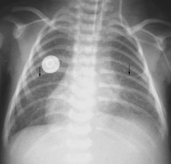 Vol. 4 No. 4 August 2010 Chest radiographic findings in children with asplenia syndrome 587 Table 2. Radiographic findings in 30 asplenic patients.