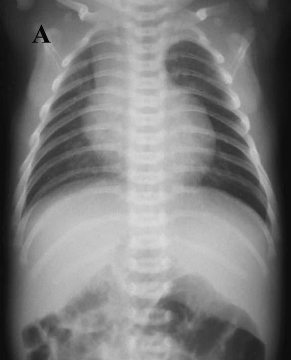 Vol. 4 No. 4 August 2010 Chest radiographic findings in children with asplenia syndrome 589 Fig.