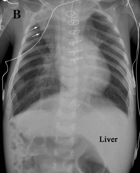 In one child (A), well-expanded right upper lobe with normal position of right minor fissure