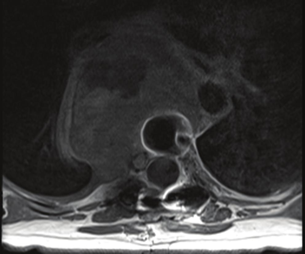 2 Case Reports in Oncological Medicine Figure 1: Axial T1 weighted