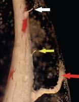 Figure 4 (5X magnification) illustrates a stereomicroscopic image of a buccal root of an upper premolar where the Hybrid Root SEAL technique obturated the entire length of the lateral canal (Grade )