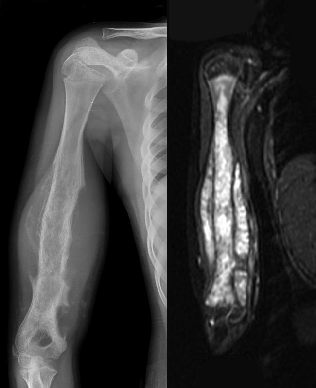THE RESULTS OF TOTAL HUMERAL REPLACEMENT FOLLOWING EXCISION FOR PRIMARY BONE TUMOUR 1279 1.0 1.0 0.8 0.8 Overall survival 0.6 0.4 Implant survival 0.6 0.4 0.2 0.2 0.0 0.0 0 20 40 60 80 100 120 Months Fig.