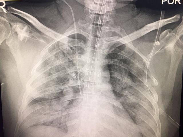 Patient was then transferred to the Intensive Care Unit (ICU), intubated and ventilated because of persistent hypoxemia and agitation on non invasive ventilation (NIV).