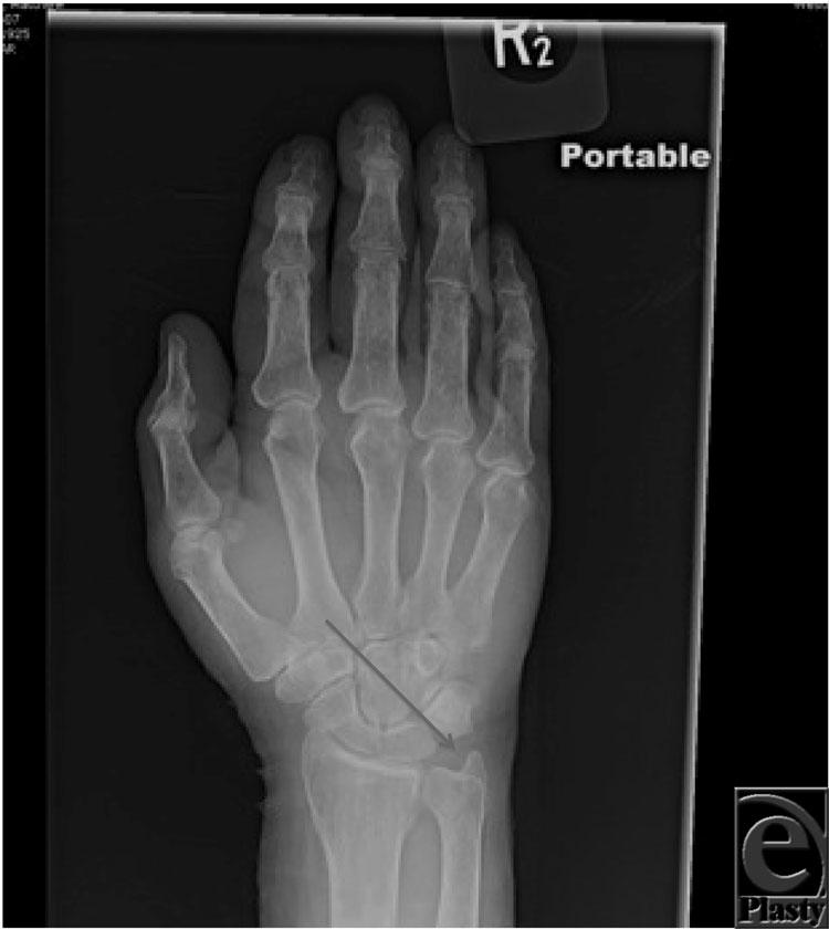 DESCRIPTION A 65-year-old patient presented with persistent ulnar-sided pain for years.
