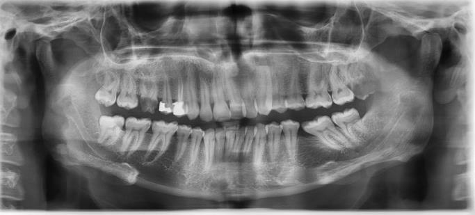 Of 128 radiographs evaluated, 6 radiographs were excluded from the study due to the absence of root formation or lack of agreement between the two observers on apex curvature.
