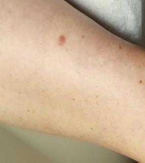 36-year-old woman with new spot on her shin