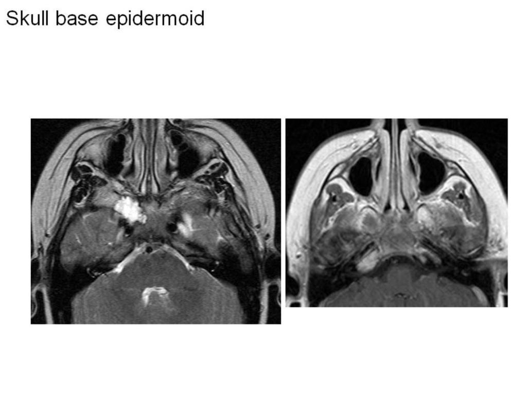 Fig. 20: epidermoid at skull base