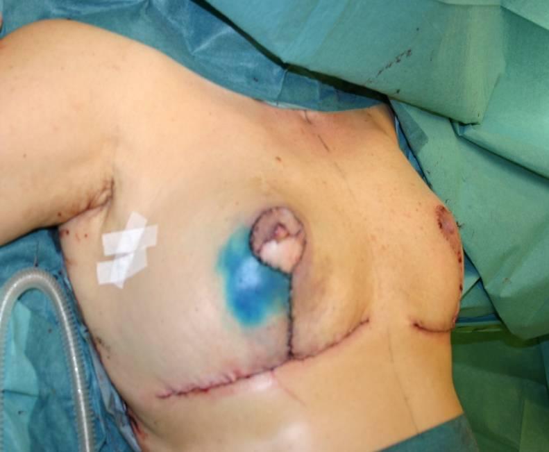 reconstruction with volume displacement technique with inferior- based flap and