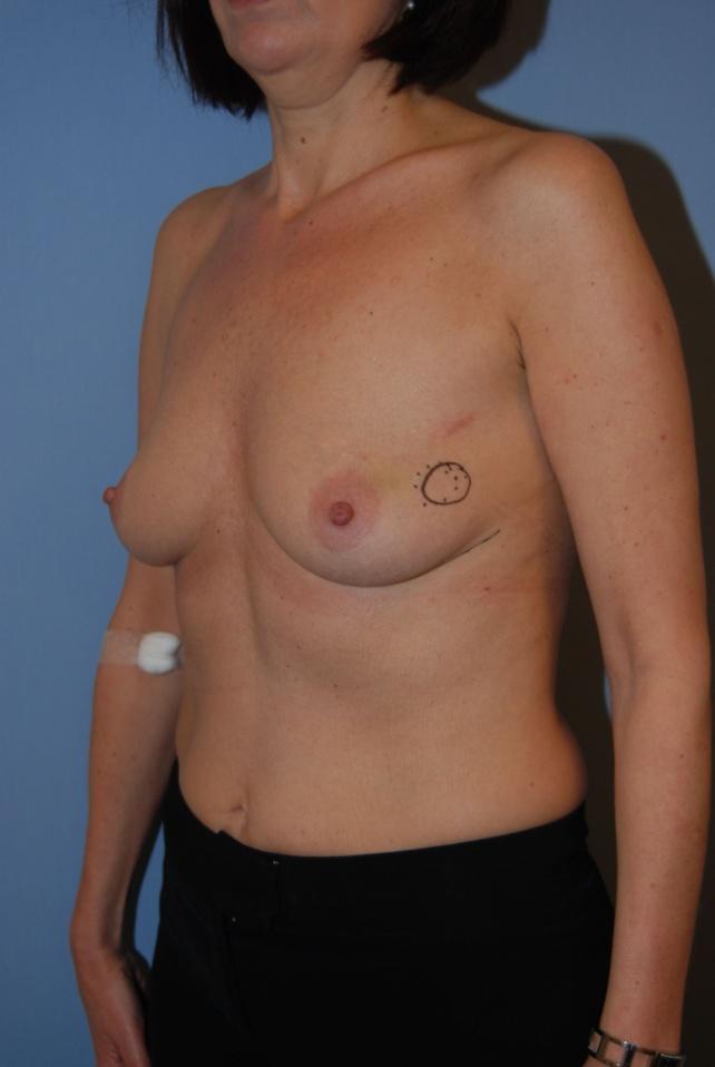Strategy Figure 5. Patient with small breasts from group IV.