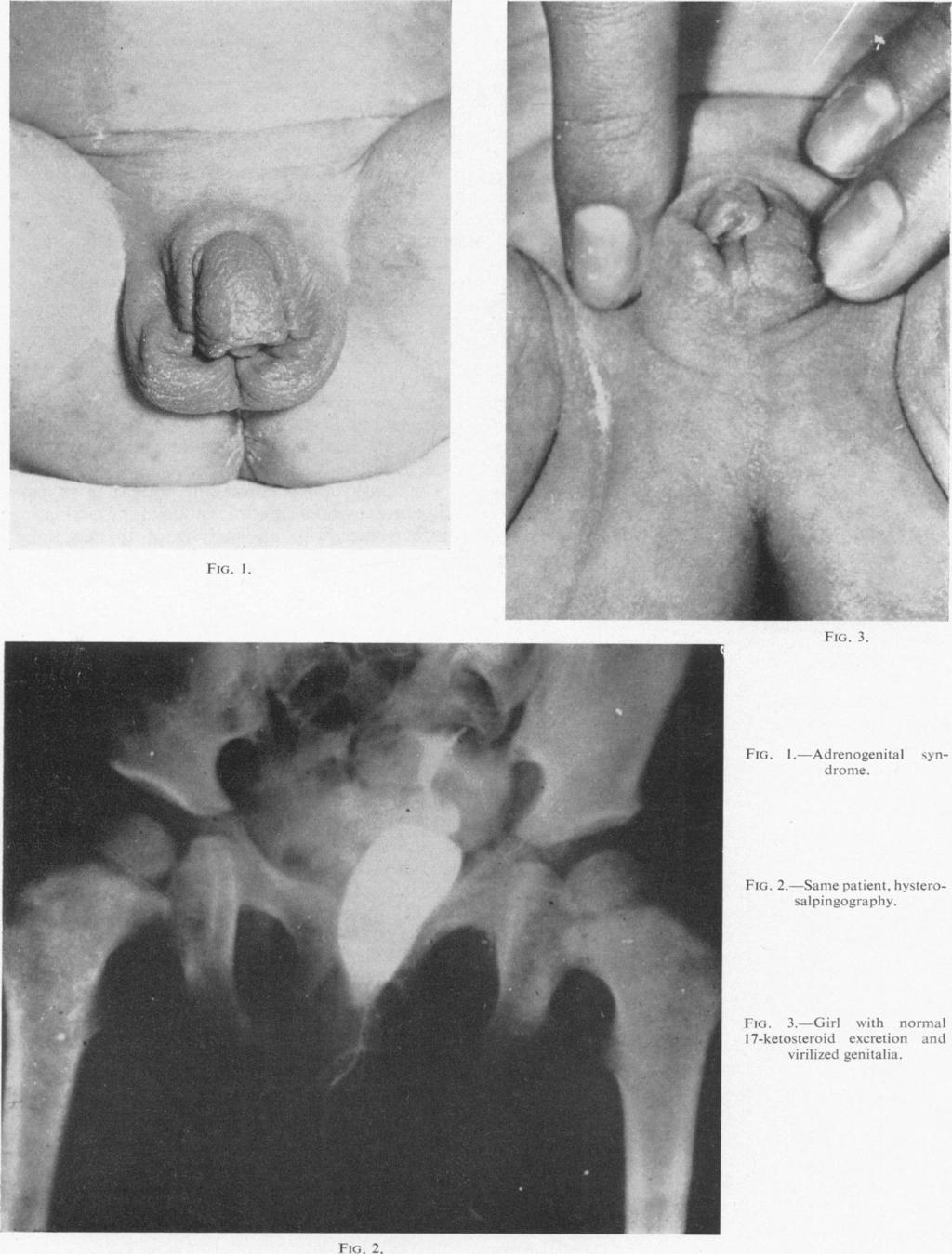 FiG,. 1. FiG. I.-Adrenogenitail syn- Jri1o'me Fiu;. 2.-Same patient, hysterosalpingo-rapivy. Arch Dis Child: first published as 10.1136/adc.35.182.402 on 1 August 1960.