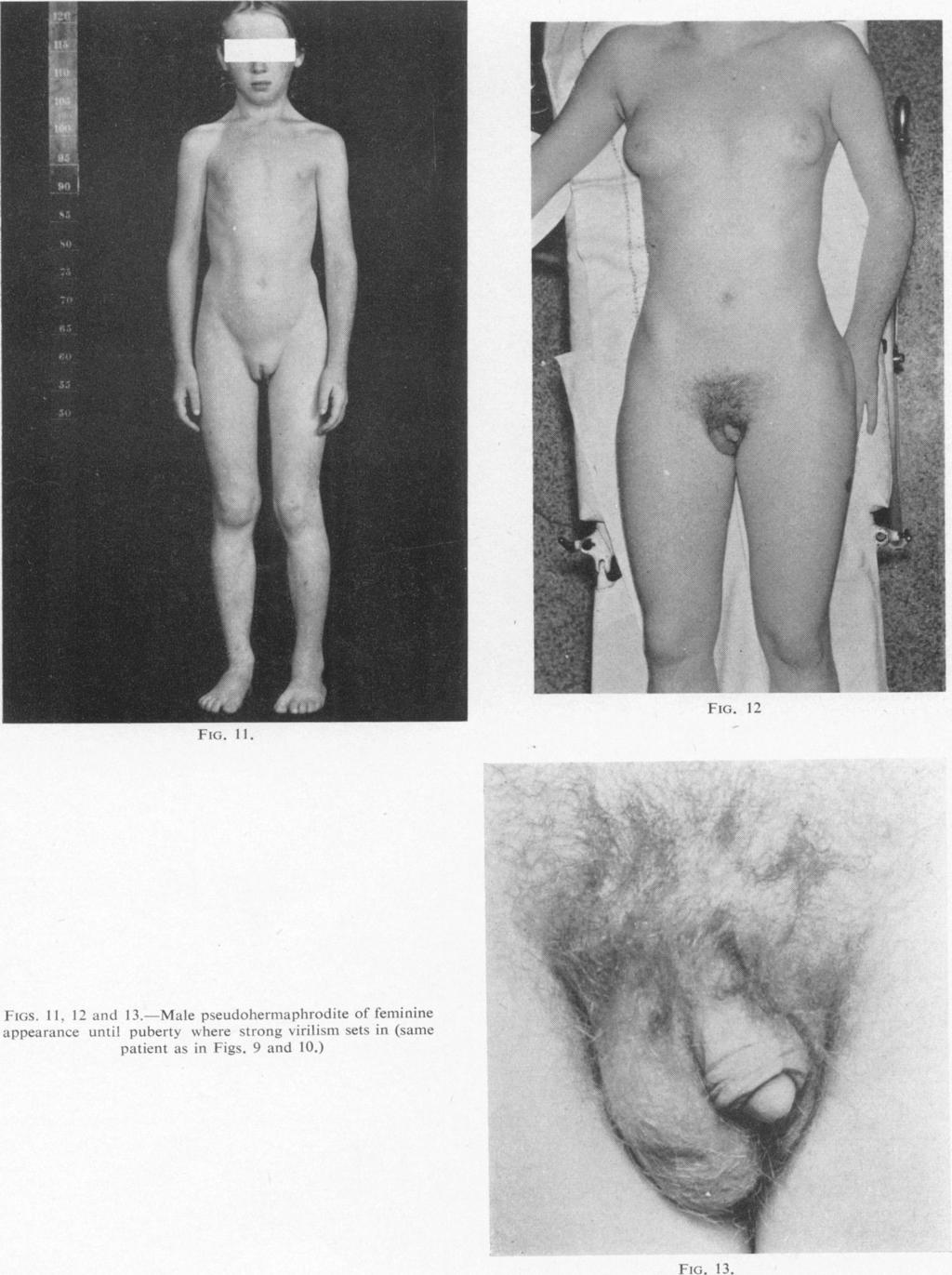 DIAGNOSIS AND TREATMENT OF HERMAPHRODITISM FIG. 1]. FIG. 12 407 Arch Dis Child: first published as 10.1136/adc.35.182.402 on 1 August 1960. Downloaded from http://adc.bmj.com/ 1I-i;s. 1!, 12 and 13.