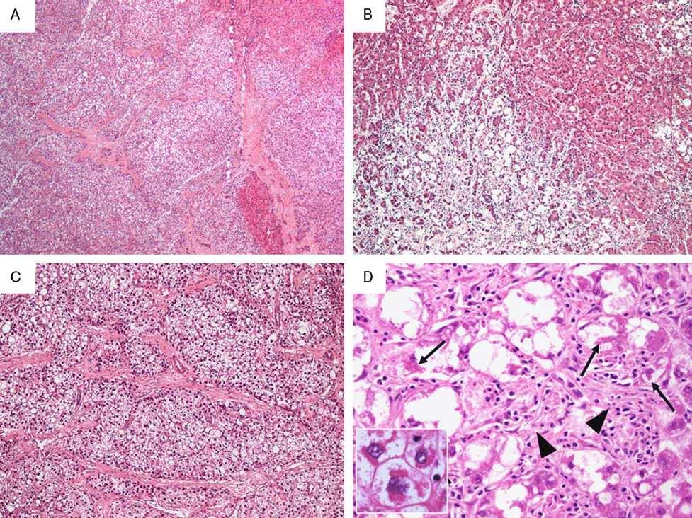 Steatohepatitic Variant of HCC, Well Differentiated Tumor Associated to Metabolic Stigmata Columbia UMC: 22 of 66 (33.