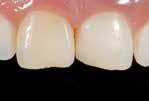 of shape and shade for improved aesthetic appearance Locking, splinting of loosened teeth Repairing veneers Restoration of deciduous teeth Core