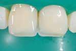 surface Compatible with all conventional bonds Clinical Cases Fillings in 14, 15 in need of replacement due to secondary caries Source: Dr.