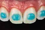 Simple and secure positioning on the tooth Illumination with UVA light following removal of