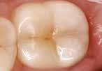 Covering of caries predilection sites during orthodontic treatments Sealing of deciduous teeth