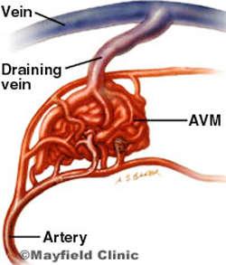 Arterio-venous malformation High-flow malformation