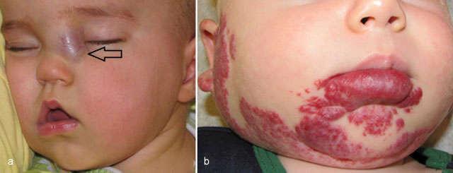 Infantile hemangioma Penetration Skin, subcutaneous tissue, or both (superficial, deep, or mixed) Pattern