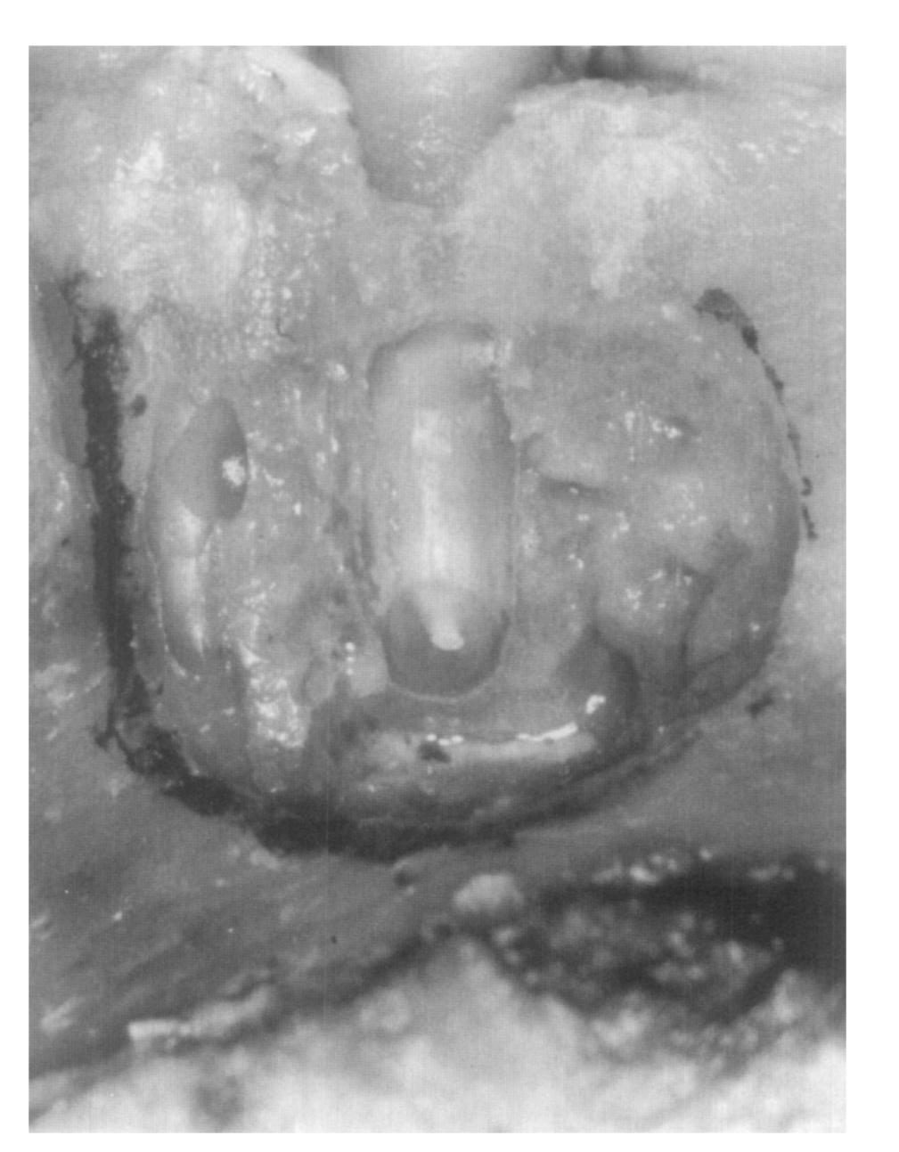 Radiograph demonstrates root-filled teeth in human cadaver before apical resection. high-speed with water cooling. The resected root surfaces were wiped with 35% phosphoric acid and airdried.