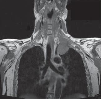 a) b) FIGURE 2 A left pancoast tumour.