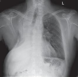He developed bronchopleural fistula and had an open pleural window 6 weeks post-operatively. b).
